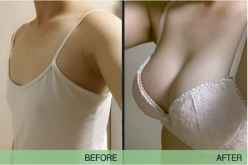胸下垂怎么修复?少女丰胸的办法 假体隆胸手术前后对比照片图