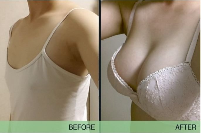 胸下垂怎么修复?少女丰胸的办法_假体隆胸手术前后对比照片图