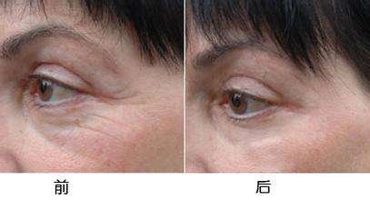 眼部注射了玻尿酸填充除皱术_打完玻尿酸的皮肤后期怎么护理?