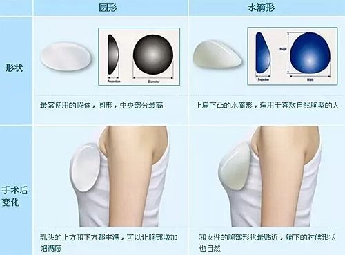 广州曙光整形医院怎么做能快速简单的丰胸?安全无痕隆胸手术办法