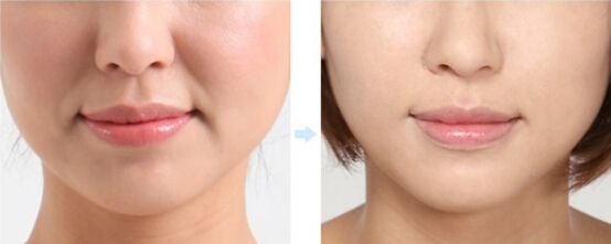 脸部填充物玻尿酸去法令皱纹怎么样?护肤的功效与保湿润滑作用
