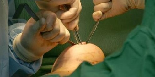 假体隆胸需要多少时间?隆胸手术的切口有哪些?丰胸手术切口哪种好