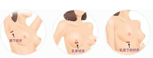 上海做假体丰胸_隆胸修复整形哪家医院最好?那里的价格多少钱?