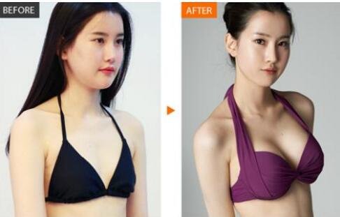 上海隆胸修复整形美容医院哪里好?手术效果怎么样?价格多少钱?