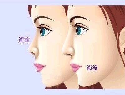 上海注射玻尿酸隆鼻安不安全?有没有副作用?会过敏吗?多久吸收完?