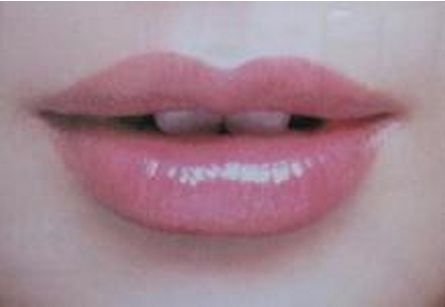 玻尿酸丰唇后有淤青怎么消除?打完了嘴巴瘙痒肿胀咋办?多久能好?