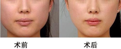 经常注射成都瘦脸针_玻尿酸填充脸颊_丰额头手术的危害有哪些?