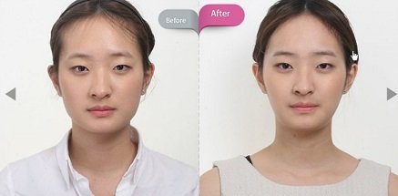 韩国国内白毒_粉毒瘦脸针真的假的?有副作用吗?多久起明显效果?