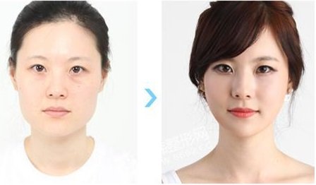 韩国下颌角突出切除收脸_脸部微整形费用大约是需要多少钱?价格表