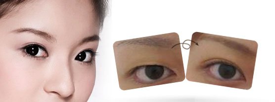 双眼皮手术术后应如何护理?