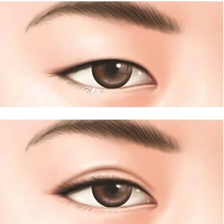 什么是韩式双眼皮?