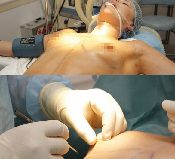 女人做胸部吸脂整形_自体抽脂丰胸_隆胸_缩胸手术全过程实拍图片