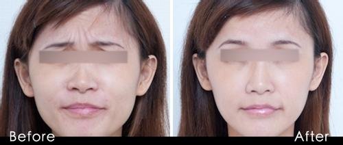 玻尿酸去眉间纹有危险嘛?打完了吃什么可以恢复快?能用化妆品吗?