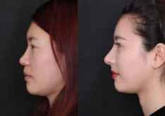 北京鼻部 鼻子修复 鼻小柱疤痕修复哪家整形医院最好?效果怎么样?