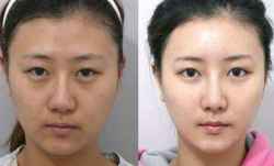 杭州哪家医院做鼻翼 鼻部整形 隆鼻修复手术好?费用是多少钱啊?