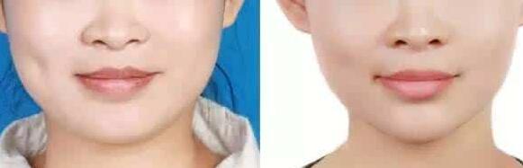 上海哪家医院的吸脂瘦脸_丰苹果肌_下颌角肥大整形整容手术最好?