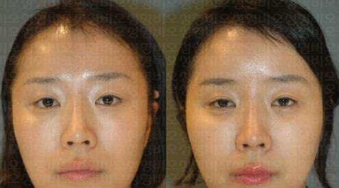 北京医院鼻翼收缩_上提_鼻综合微整形_3d隆鼻手术费用要多少钱?