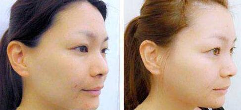 重庆医院注射瘦脸针_打溶脂针_吸脂瘦脸整容整形手术哪里比较好?