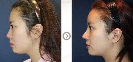 杭州学生现在做一次微创_真皮隆鼻美容手术需要多少钱呢?价格表