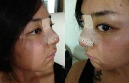 在温州做一次专业硅胶隆鼻_无创无痛隆鼻手术价格一般是多少钱?
