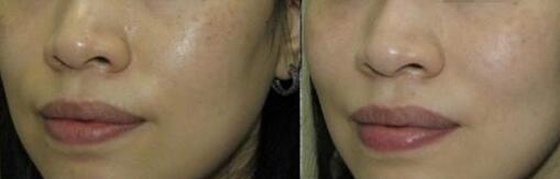 用祛斑霜对皮肤伤害大吗?用后脸特别干_红肿红痒脱皮敏感怎么办?