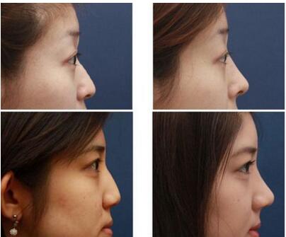 南京整容医院好的韩式纳米仿生假体形隆鼻尖手术价格是多少钱啊?