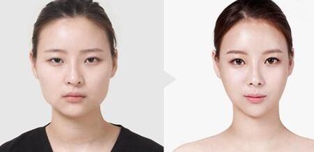 现在在北京用韩式的4d隆鼻子术做一次无创整形需要花费多少钱呢?