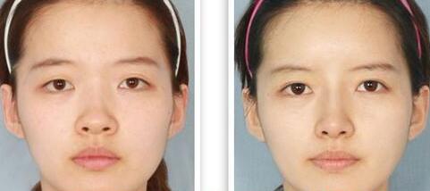 杭州液体硅胶假体隆鼻修复手术后注射物取出来几天能恢复原样吗?
