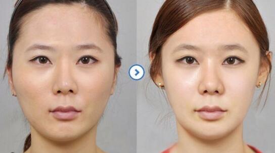上海哪家大的整形医院打造网红脸最好?九院_曼迪里能做网红脸吗?