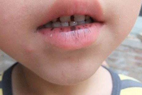 嘴唇上长的雀斑怎么样去除掉?如何消除黑斑?去斑最佳的方法