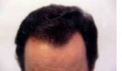 男性型头发油腻脱发怎么办?治疗出油脂溢性脱发的方法药物