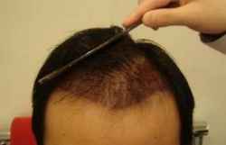 男人头发突然容易掉的厉害怎么办呢?是什么原因导致的?吃什么药好