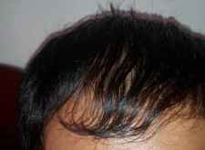 脂溢性皮炎导致脱发还会长头发吗?怎么办?能治愈吗治疗要吃什么药