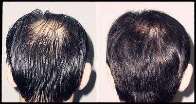 最近脱发很严重是怎么回事?什么原因造成的?最有效的防脱发方法