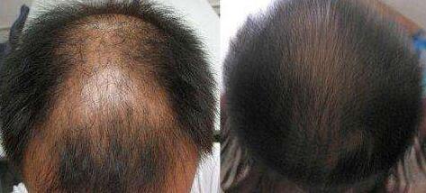 脂溢性脱发能治好吗?怎么治疗可以使头发不出油?用什么洗发水好?