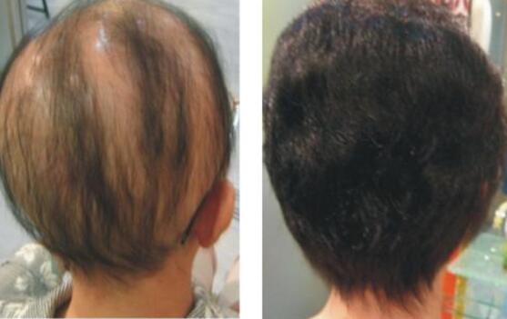 神经性脱发怎么样治疗的?症状表现什么原因造成的?治疗方法