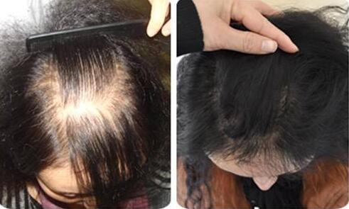 黑豆泡醋能治疗脱发吗?怎么吃有效果?防治脱发生发的方法_偏方