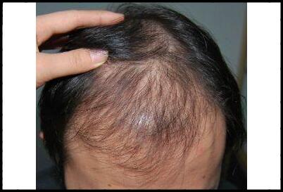 雄性激素脱发是怎么回事?什么意思?怎么治疗调理?防止脱发的方法