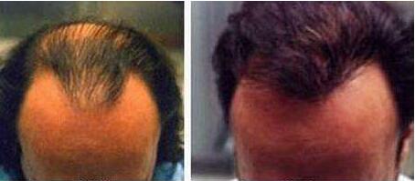 油脂性脱发是什么原因_症状?要经常洗头吗?治疗脱发的方法小窍门