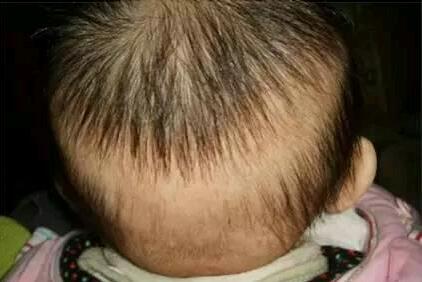新生儿头顶发多发少脱发是怎么回事啊?儿童脱发原因及治疗方法