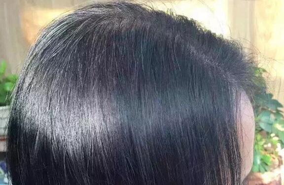 鬓角长白发是怎么回事?怎么治疗白发才能变黑?黑发的食物药方