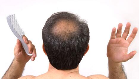 男性脱发是什么原因引起的?怎么调理才能长?吃什么食物维生素好补