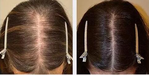 女性脂溢性脱发的症状特征如何治疗?治疗方法植发吗?用啥洗发水好