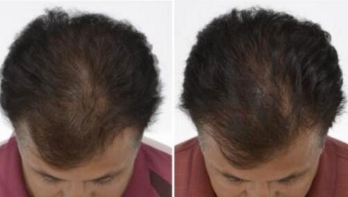 最近老脱发厉害怎么回事?很严重怎么办?有什么方法可以防止脱发