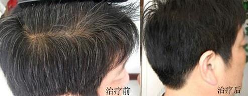 减少黑发有哪些方法?马铃薯皮煮水洗头发能把白发变黑发吗?