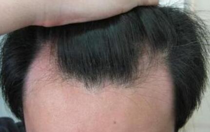 缺钙铁锌贫血性会引起脱发吗?导致脱发吃什么药可以恢复好
