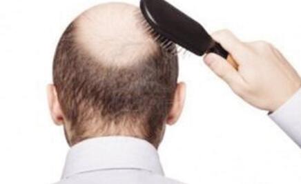 男人头顶脱发落发怎么回事?头发稀少怎么办?吃什么药能治疗好?