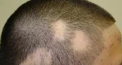 脱发分为哪几种类型?到底能不能治疗好?初期如何治疗?方法图片