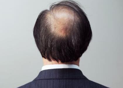 遗传脱发能不能治好?怎么治疗?脱发原因及最好的治疗方法有哪些?