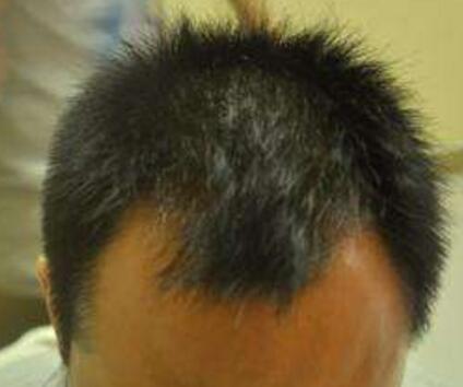额角脱发是什么原因?属于什么脱发?能长出来吗?可以多久恢复?